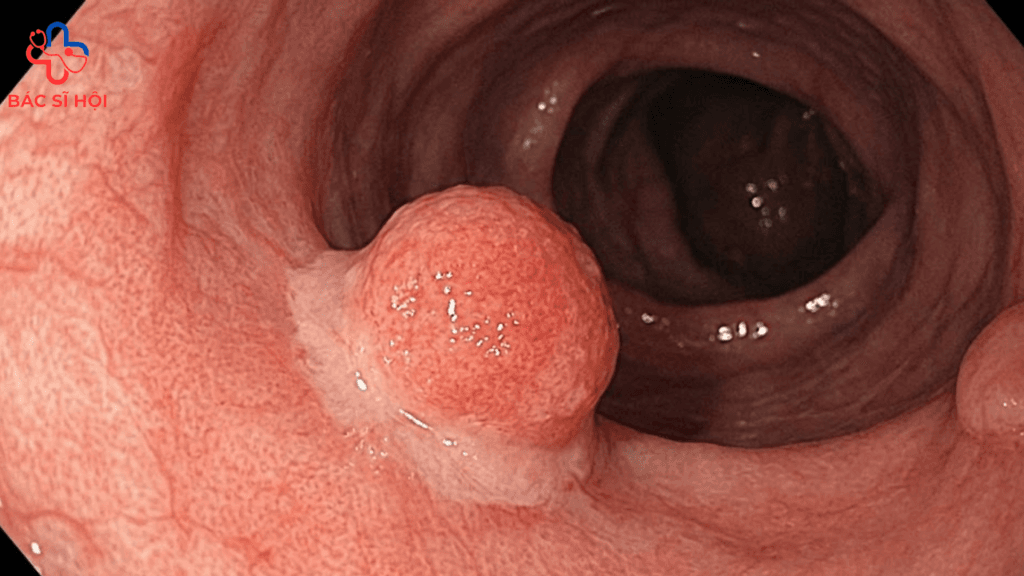 Polyp dạ dày